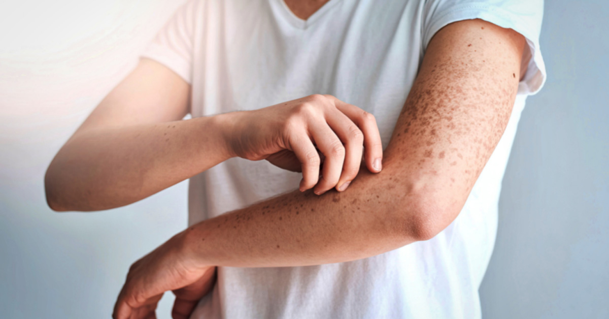 Mast Cell Activation Syndrome (MCAS) Therapy: Evidence-Based Psychological Care
