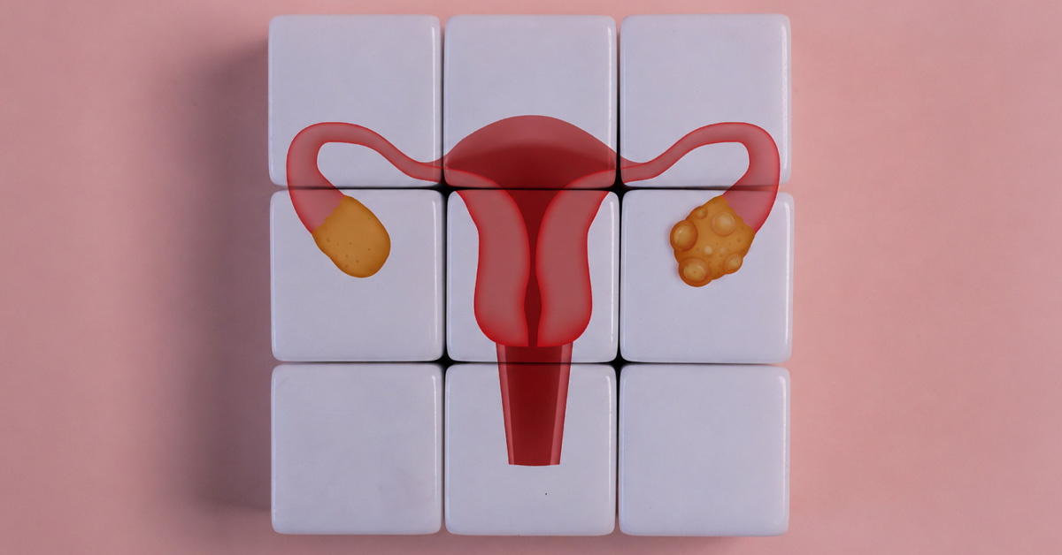 Polycystic Ovary Syndrome (PCOS) Therapy: Evidence-based Mind-Body Care